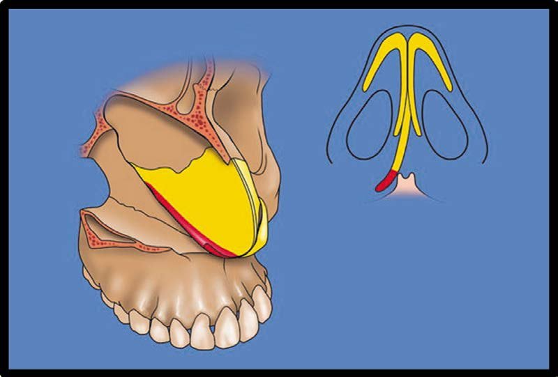 . Redundant caudal septum (red) to be excised. (From Rohrich RJ.