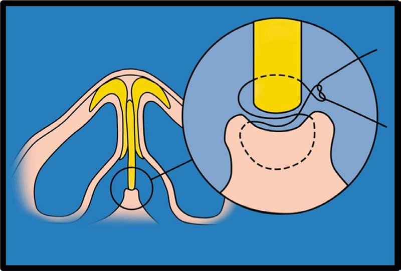 . Figure-of-eight polydioxanone suture securing caudal septum to