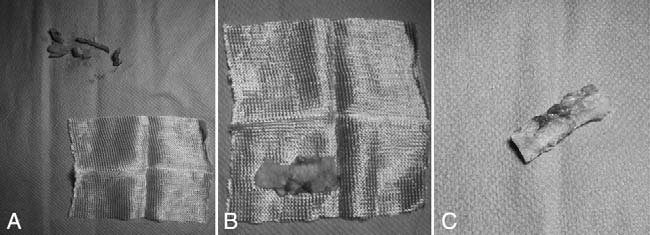 . (A) Cartilagefragmentsandsurgicelpreparation.(B) Moderately