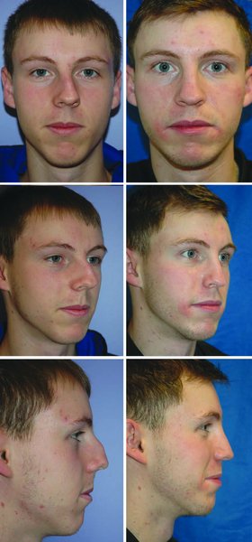 . (Continued ). . . Preoperative and postoperative photo-