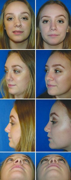 . (Continued ). . . Preoperative and postoperative photographs lip repair withou