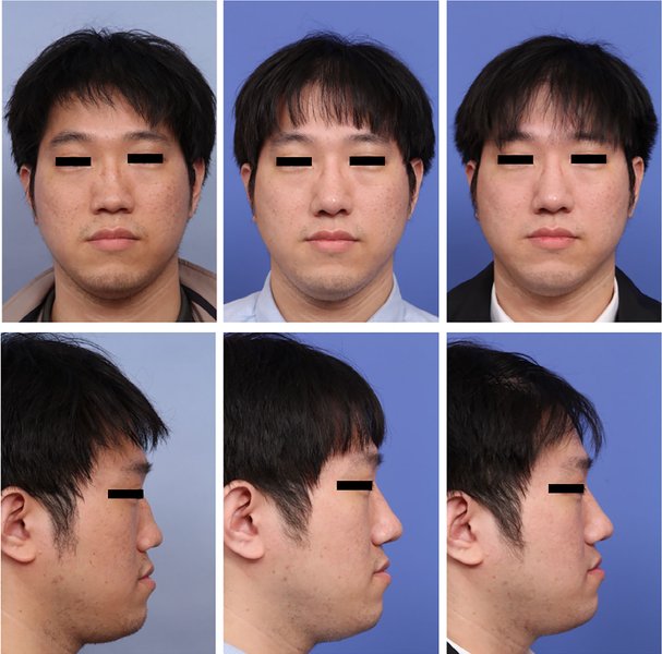 . A patient with saddle nose. Preoperative (left) and 12months postoperative (mi