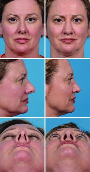 . (Left) A 47-year-old woman presented for aesthetic correction of her nose