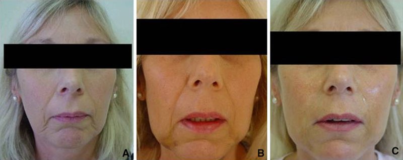 Exemplificativecaseoffacialrejuvenation. Apatienttreatedfortheredefinitionofthem