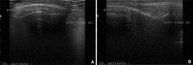 Ultrasoundevaluationofthetreatedzygomaticarea long-lasting fibrosis around the t