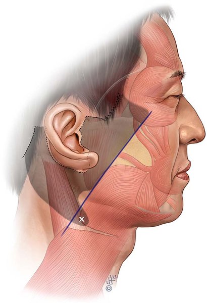 . The skin incisions are as shown by the dotted line. The blue