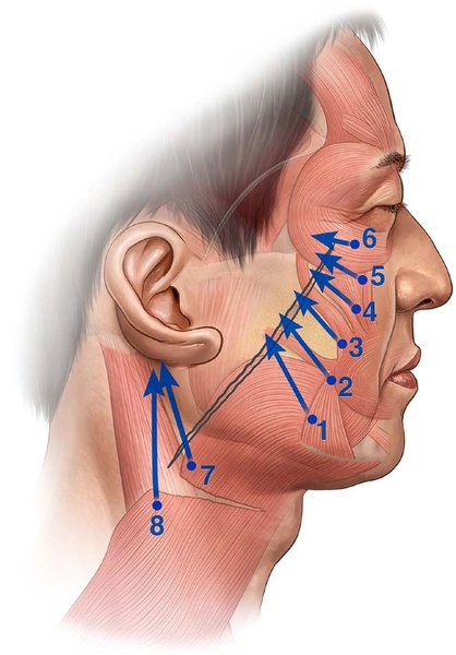 . Suture placement locations. Suture 1 is placed at the