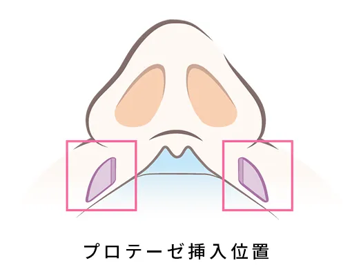 鼻翼基底部プロテーゼ