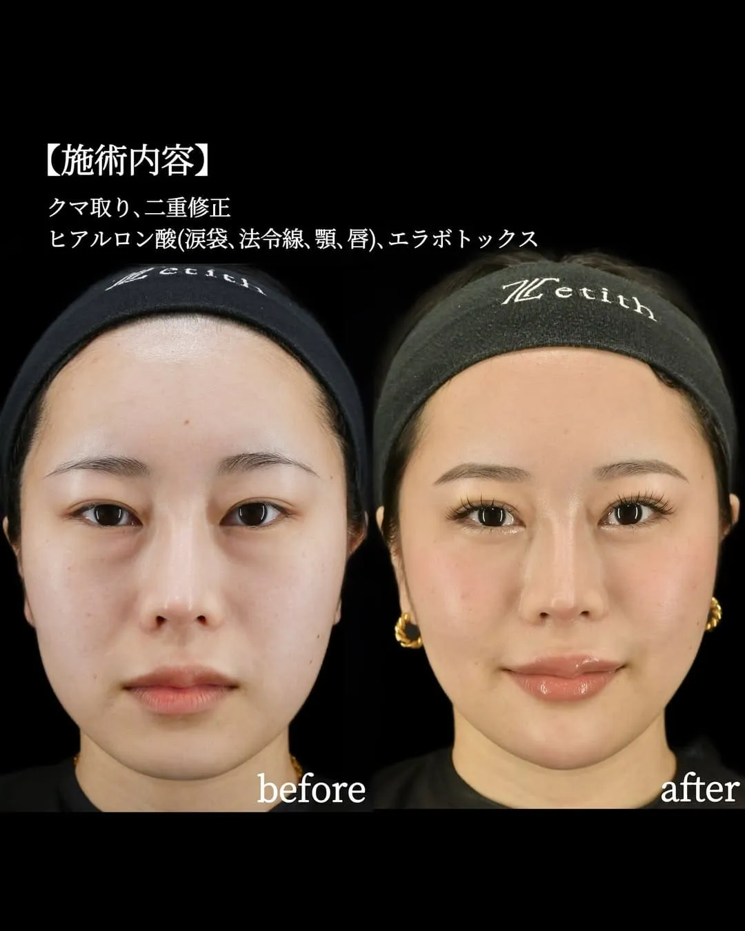 二重整形のビフォーアフター写真(術前)