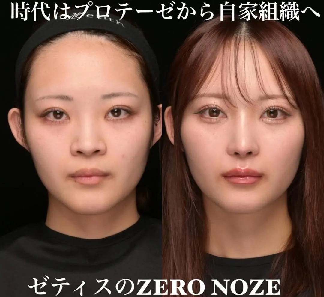 鼻整形のビフォーアフター写真(術前)