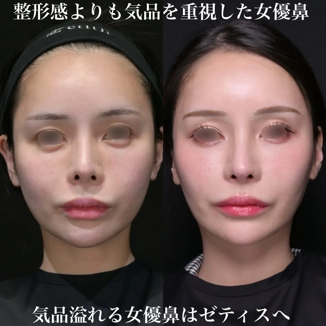 女優鼻