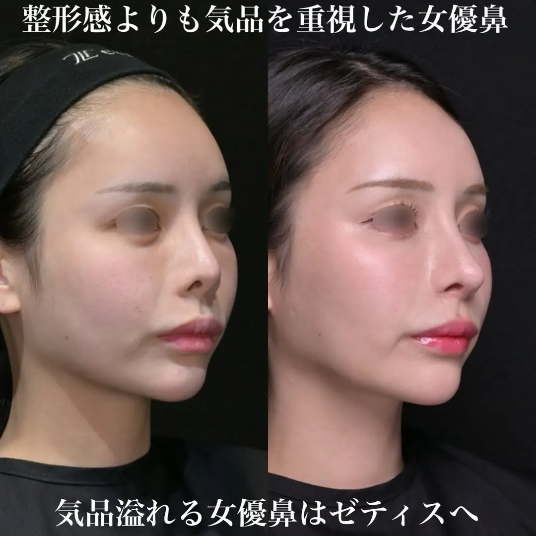 女優鼻