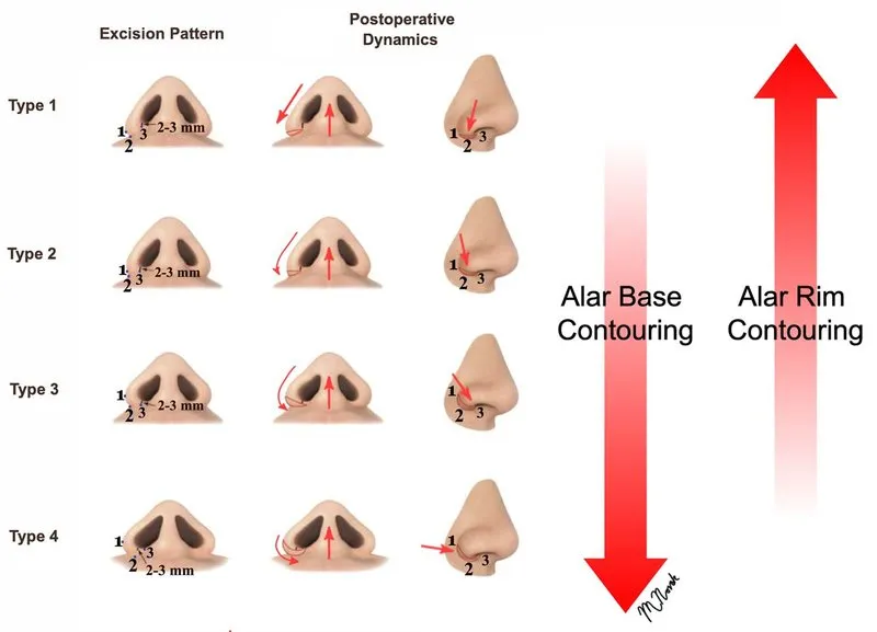 . The alar base surgery spectrum, showing resection patterns and postoperative dynamics for each type of alar flare.