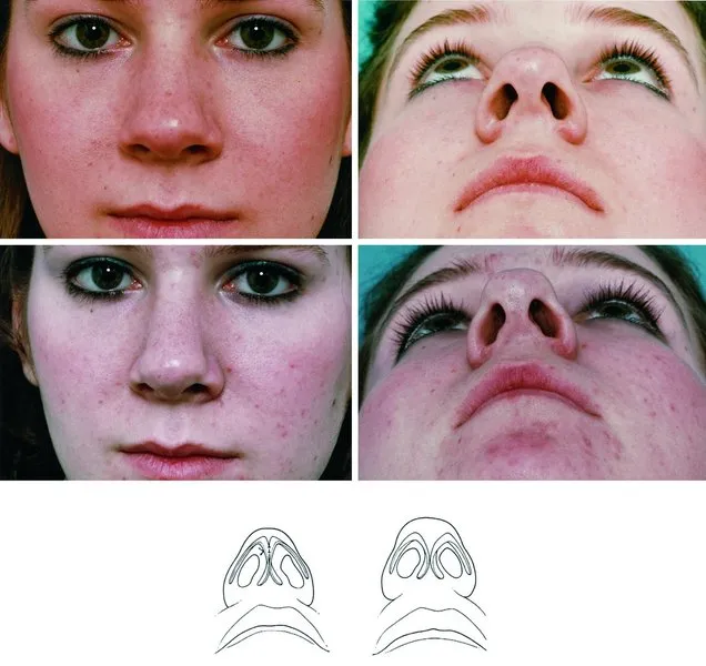 . (Above) A patient whose bulbous tip was caused in large measure by an excessive angle of the inter
