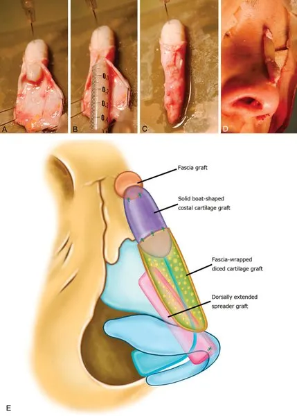 Techniqueofhybridnasaldorsalgrafts.(A) Thetemporalfasciaissuturedtothesolidboat-shapedcostalcartilagegraft.(B) Diced