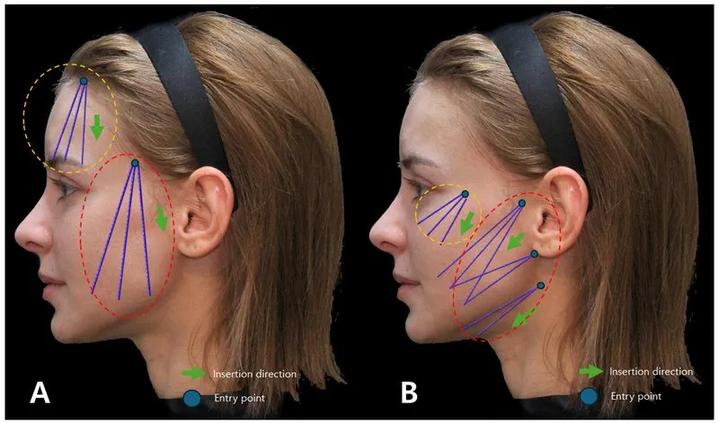 . Displays the structural variances between layers covering and not covering the bones