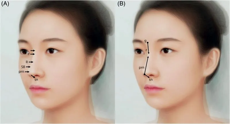 Thesequenceofastructuredfillerrhinoplasty(A) witha27Gneedle,(B) witha23Gcannula. g, glabella; r, radix; R, rhinion; SB,