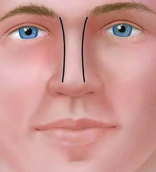 . The nasal dorsum of a man is wider and straighter (repro-