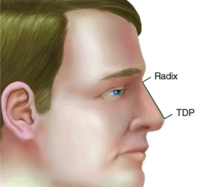 . The nasal dorsum should lie along a straight line from the