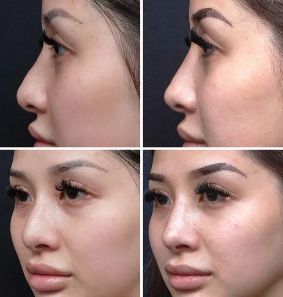 . Before-and-after photographs of a 28-year-old woman who desired a straighter,