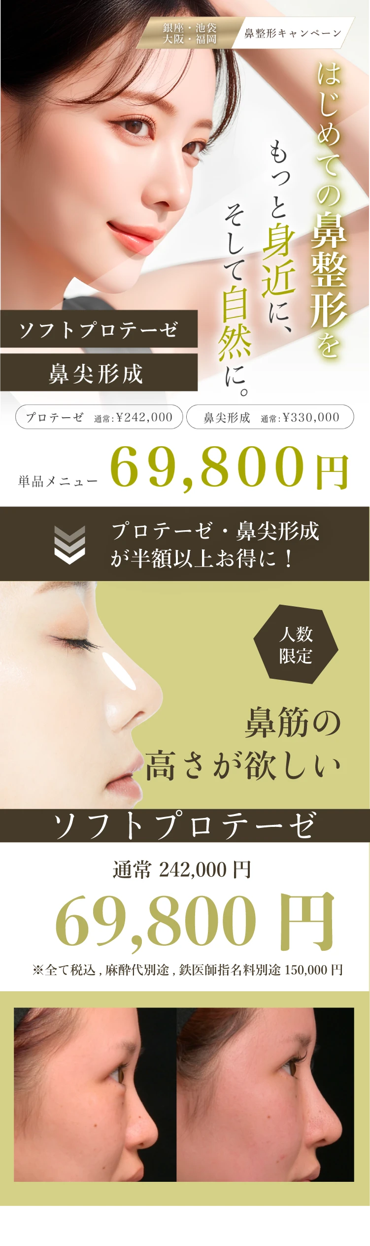 鼻を高く、鼻先を美しく！プロテーゼ・鼻尖形成キャンペーン