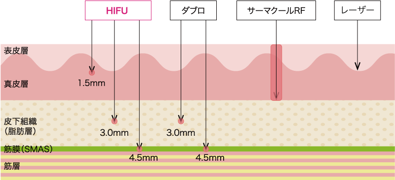 たるみ治療の比較
