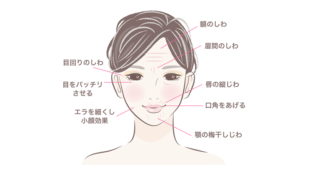 しわ、小顔治療の適応部位