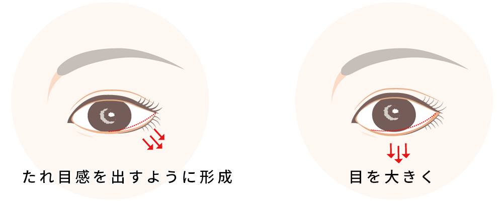 下眼瞼下制 (皮膚切開法)