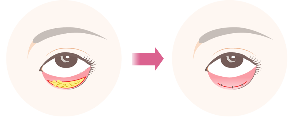 切らないたるみ取り（経結膜脱脂）とは