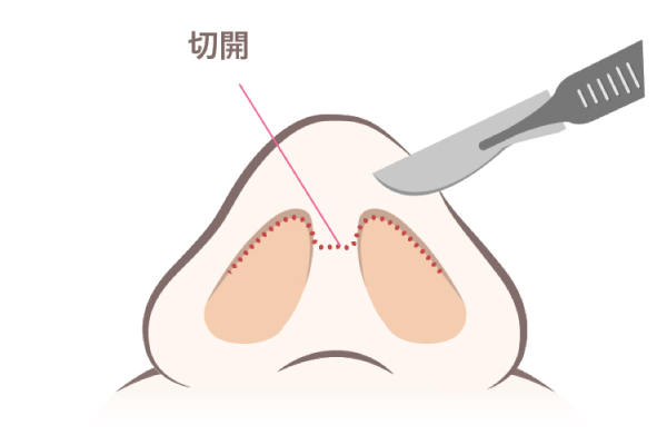 切開箇所