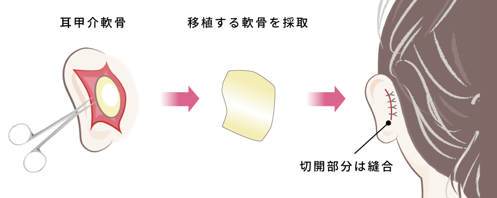 軟骨採取のイメージ