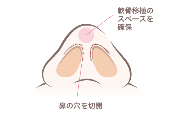 軟骨移植のスペースを確保