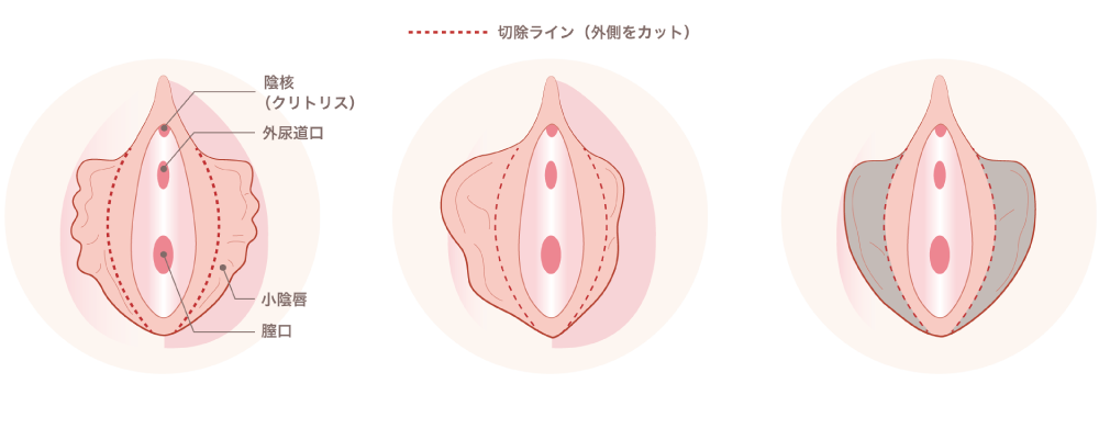 小陰唇のトラブルで起こる症状