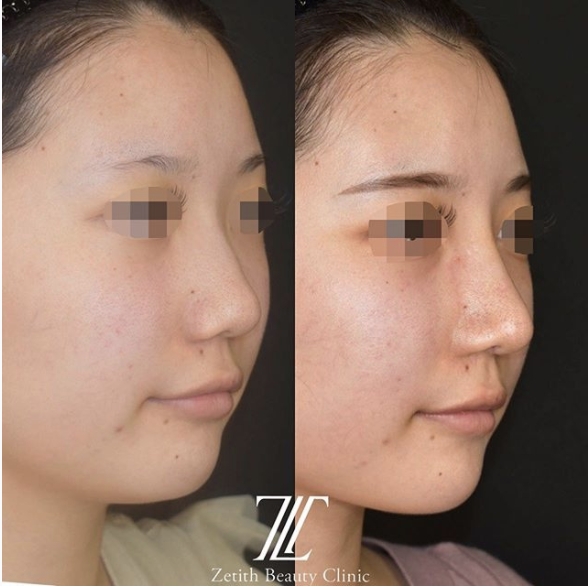 鉄医師による鼻のフルコース施術前／施術後1週間 施術後 
