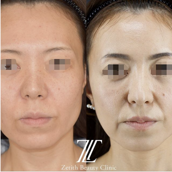 鉄医師による鼻のフルコースの施術前／施術後３ヶ月