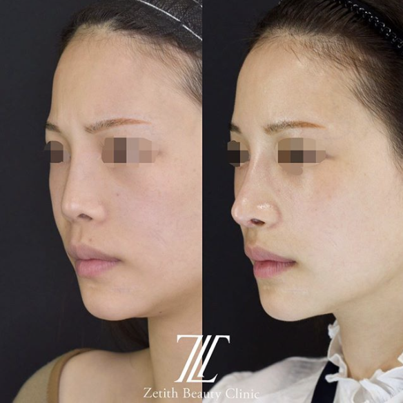 鉄医師による鼻のフルコースの施術前／施術後６ヶ月 术后 