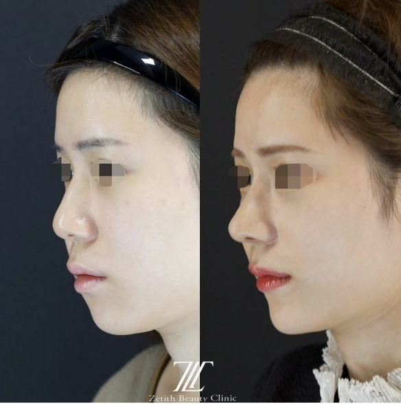 鉄医師による鼻のフルコースの施術前／施術後１ヶ月 术后 