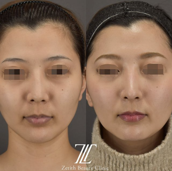 鉄医師による鼻のフルコースの施術前／施術後３ヶ月 术后 