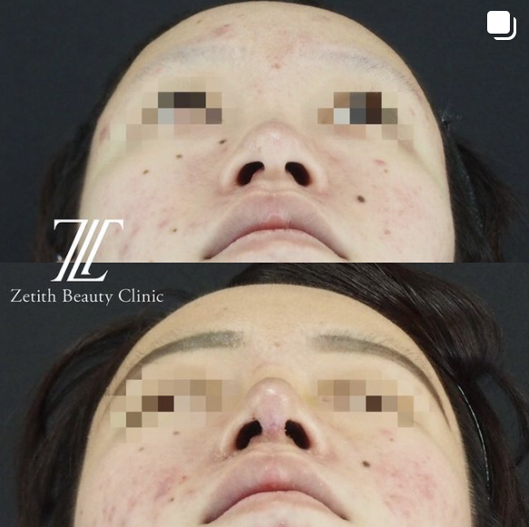 守屋医師による鼻尖形成＋耳介軟骨移植(コルメラストラット法併用)の施術前／施術後１週間 术后 