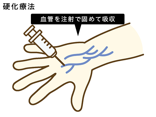 硬化療法