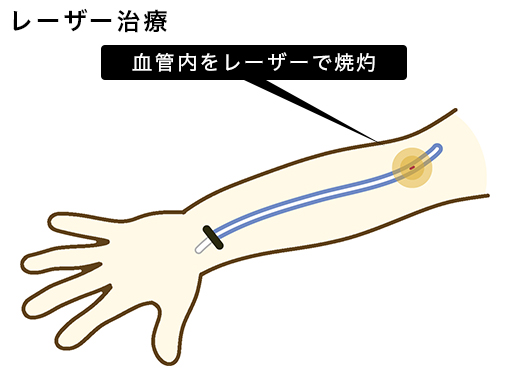 レーザー治療の内容