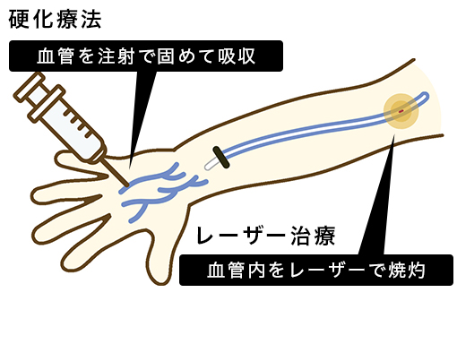 レーザー治療
