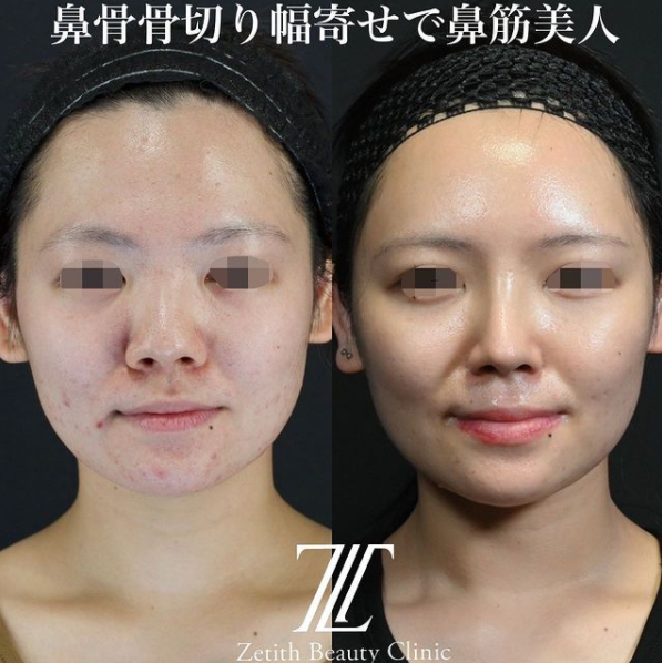鉄医師による鼻のフルコースの施術前／施術後1ヶ月