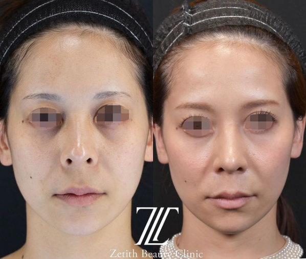 鉄医師による鼻のフルコースの施術前／施術後3ヶ月 Дараа 