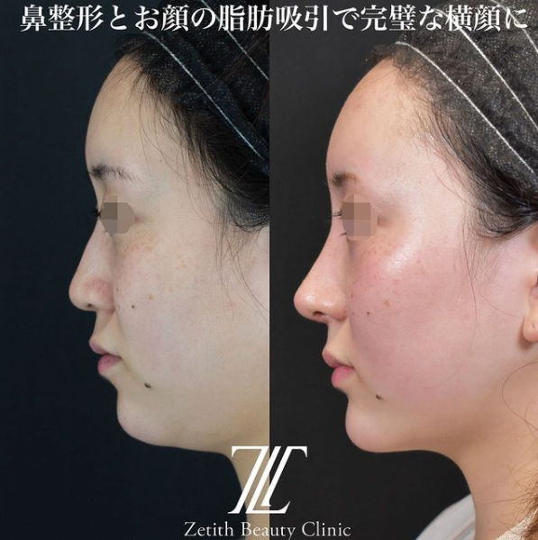鉄医師による鼻のフルコースの施術前／施術後3ヶ月