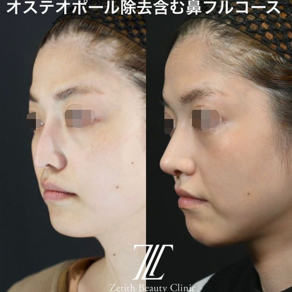 鉄医師による鼻のフルコースの施術前／施術後1ヶ月 施術後 