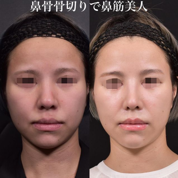 鉄医師による鼻のフルコースの施術前／施術後1ヶ月