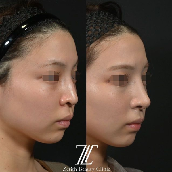 鉄医師による鼻のフルコースの施術前／施術後1ヶ月 术后 