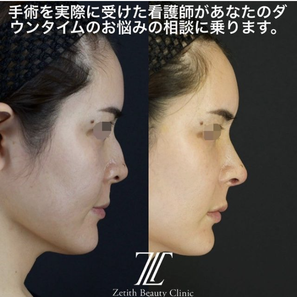 鉄医師による鼻のフルコースの施術前／施術後 หลัง 
