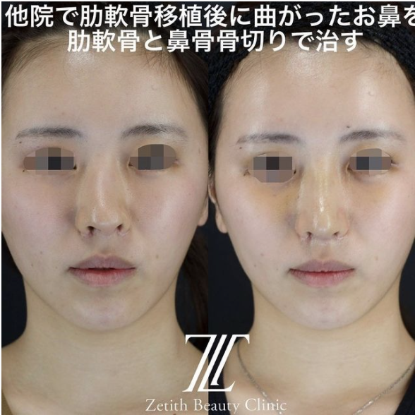 鉄医師による鼻のフルコースの施術前／施術後１週間 施術後 